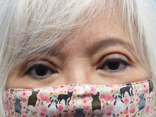 Haena Kim, MD eyelid lift after — San Jose, CA