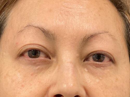 Blepharoplasty before at Haena Kim, MD in San Jose, CA