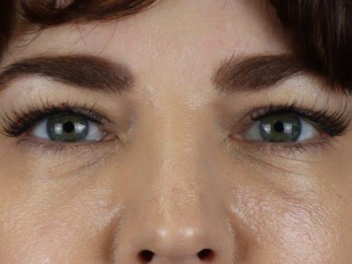 Blepharoplasty after at Haena Kim, MD in San Jose, CA