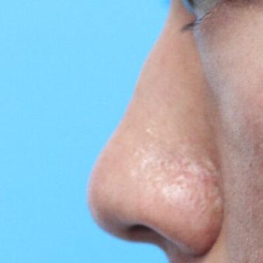 Rhinoplasty before at Haena Kim, MD in San Jose, CA