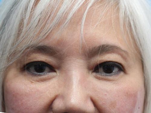 Blepharoplasty before at Haena Kim, MD in San Jose, CA