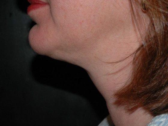 Neck Liposuction after at Carmel Cosmetic and Plastic Surgeons in Carmel, IN