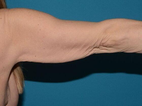 Arm Lift before at Carmel Cosmetic and Plastic Surgeons in Carmel, IN