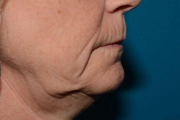 Fat Transfer before at Carmel Cosmetic and Plastic Surgeons in Carmel, IN