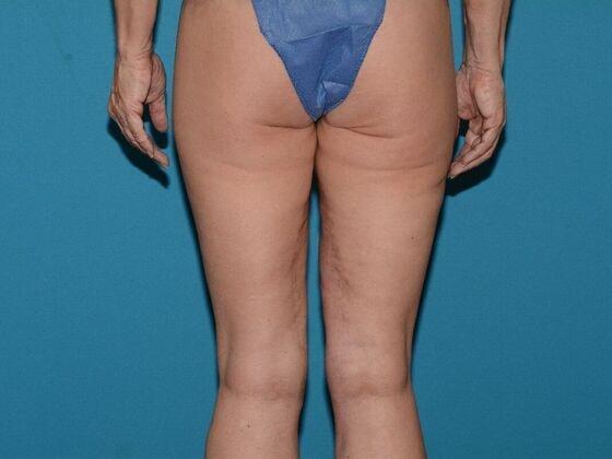 Thigh Lift after at Carmel Cosmetic and Plastic Surgeons in Carmel, IN