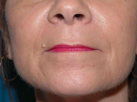 Fat Transfer after at Carmel Cosmetic and Plastic Surgeons in Carmel, IN