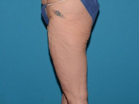 Thigh Lift before at Carmel Cosmetic and Plastic Surgeons in Carmel, IN