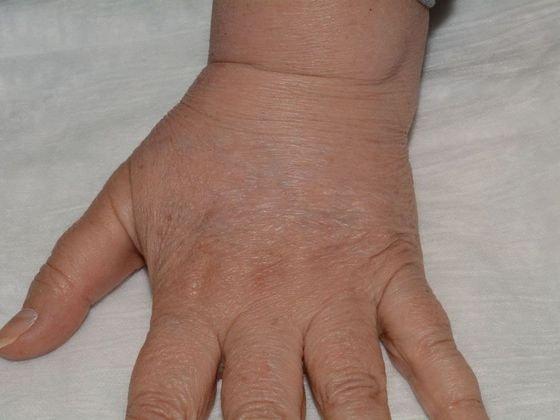 Fat Transfer after at Carmel Cosmetic and Plastic Surgeons in Carmel, IN