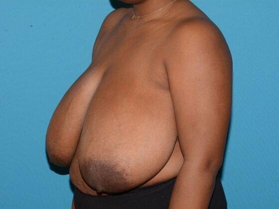 Breast Reduction before at Carmel Cosmetic and Plastic Surgeons in Carmel, IN