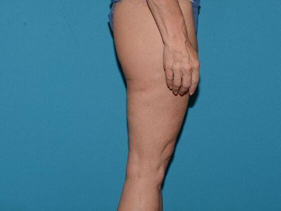 Thigh Lift after at Carmel Cosmetic and Plastic Surgeons in Carmel, IN