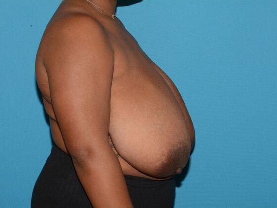 Breast Reduction before at Carmel Cosmetic and Plastic Surgeons in Carmel, IN