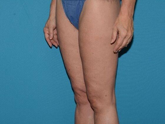 Thigh Lift after at Carmel Cosmetic and Plastic Surgeons in Carmel, IN