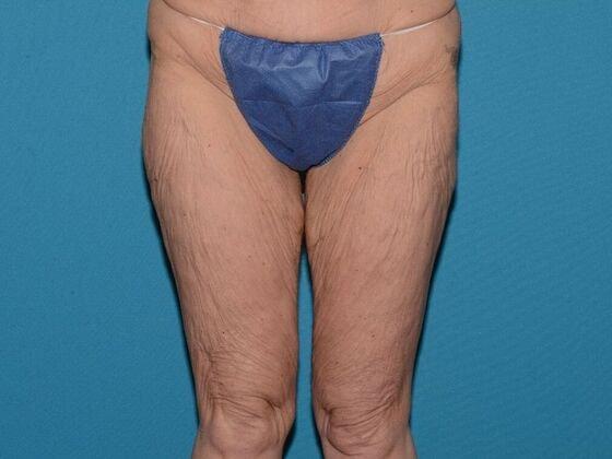 Thigh Lift before at Carmel Cosmetic and Plastic Surgeons in Carmel, IN