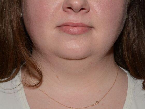 Neck Liposuction before at Carmel Cosmetic and Plastic Surgeons in Carmel, IN