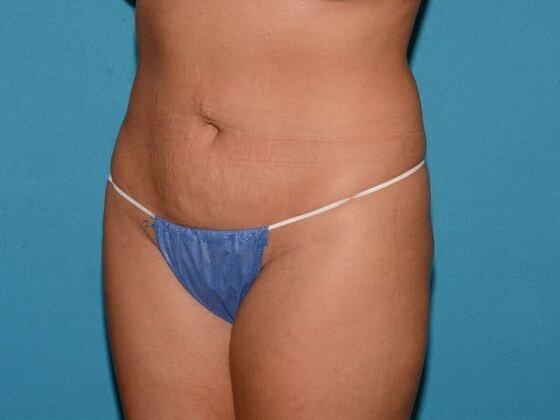 Liposuction after at Carmel Cosmetic and Plastic Surgeons in Carmel, IN