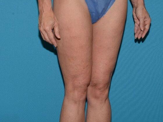 Thigh Lift after at Carmel Cosmetic and Plastic Surgeons in Carmel, IN