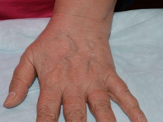 Fat Transfer before at Carmel Cosmetic and Plastic Surgeons in Carmel, IN