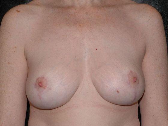 Breast Lift after at Carmel Cosmetic and Plastic Surgeons in Carmel, IN