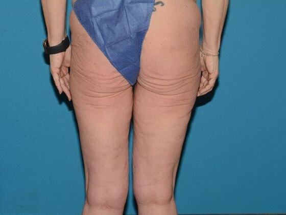 Thigh Lift before at Carmel Cosmetic and Plastic Surgeons in Carmel, IN