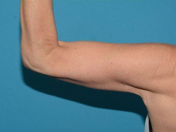 Carmel Cosmetic and Plastic Surgeons arm lift after — Carmel, IN