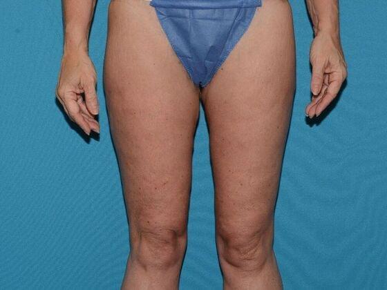 Thigh Lift after at Carmel Cosmetic and Plastic Surgeons in Carmel, IN