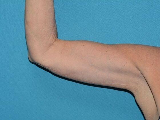 Carmel Cosmetic and Plastic Surgeons arm lift after — Carmel, IN