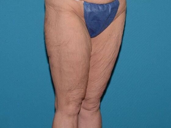 Thigh Lift before at Carmel Cosmetic and Plastic Surgeons in Carmel, IN