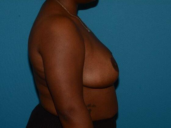 Breast Reduction after at Carmel Cosmetic and Plastic Surgeons in Carmel, IN
