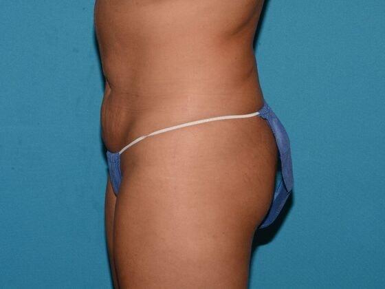 Liposuction after at Carmel Cosmetic and Plastic Surgeons in Carmel, IN