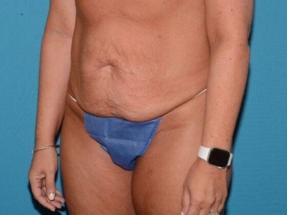 Mini Tummy Tuck before at Carmel Cosmetic and Plastic Surgeons in Carmel, IN
