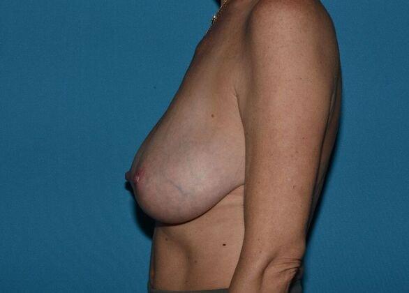 Breast Reduction before at Carmel Cosmetic and Plastic Surgeons in Carmel, IN
