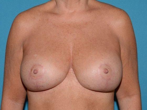 Breast Lift after at Carmel Cosmetic and Plastic Surgeons in Carmel, IN