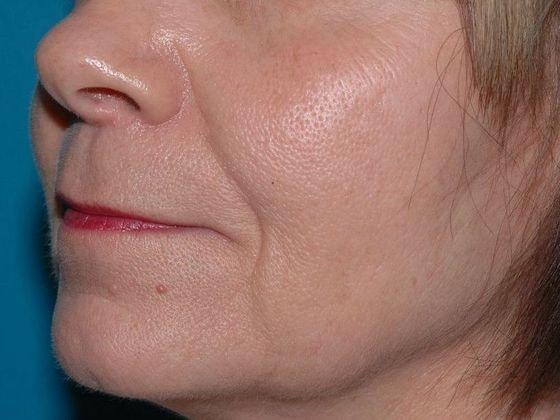Fat Transfer before at Carmel Cosmetic and Plastic Surgeons in Carmel, IN