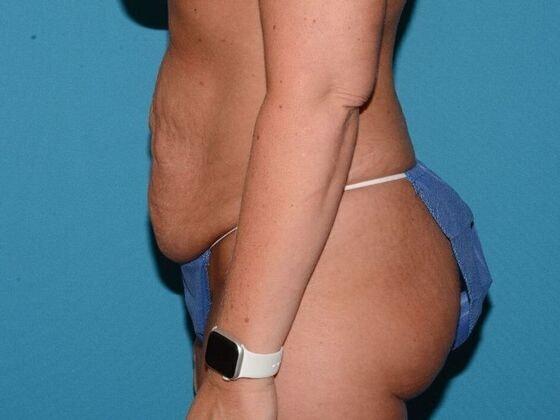 Mini Tummy Tuck before at Carmel Cosmetic and Plastic Surgeons in Carmel, IN
