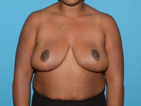 Breast Reduction after at Carmel Cosmetic and Plastic Surgeons in Carmel, IN