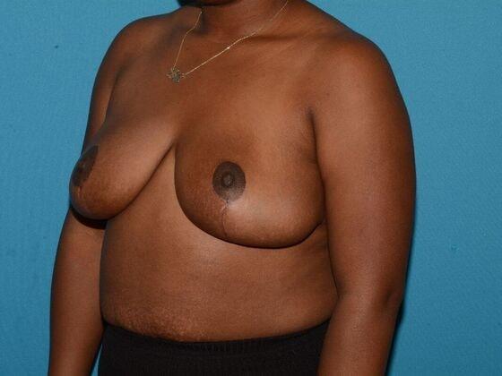 Breast Reduction after at Carmel Cosmetic and Plastic Surgeons in Carmel, IN