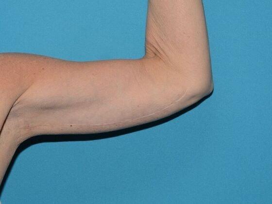 Carmel Cosmetic and Plastic Surgeons arm lift after — Carmel, IN