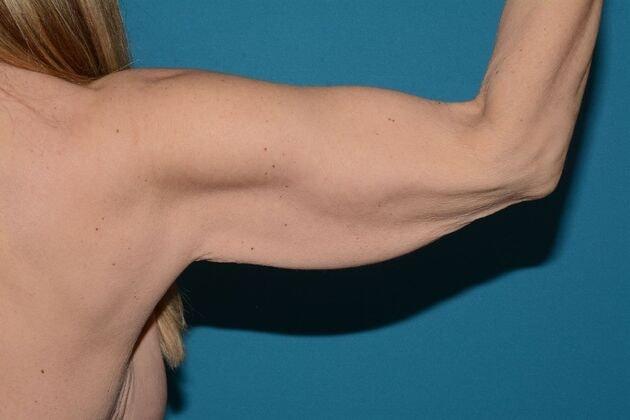 Arm Lift before at Carmel Cosmetic and Plastic Surgeons in Carmel, IN