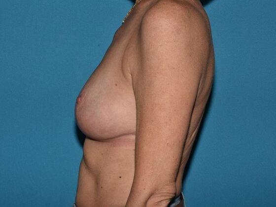 Breast Reduction after at Carmel Cosmetic and Plastic Surgeons in Carmel, IN
