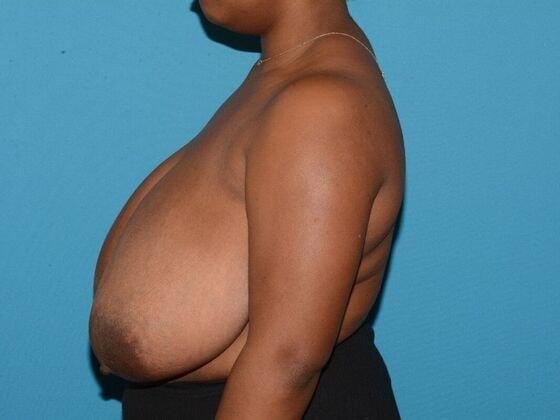 Breast Reduction before at Carmel Cosmetic and Plastic Surgeons in Carmel, IN