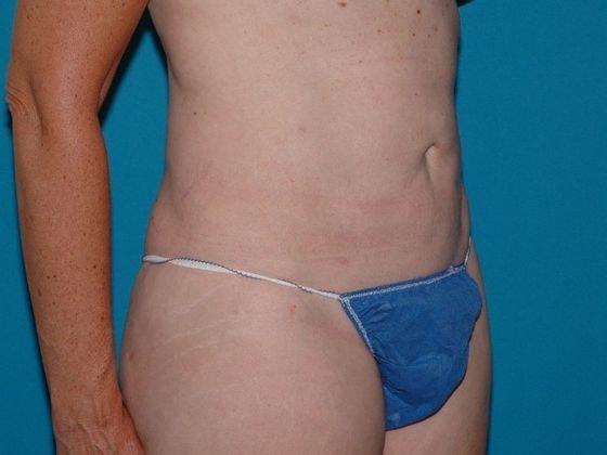 Liposuction after at Carmel Cosmetic and Plastic Surgeons in Carmel, IN