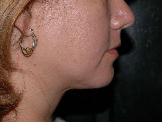 Neck Liposuction after at Carmel Cosmetic and Plastic Surgeons in Carmel, IN