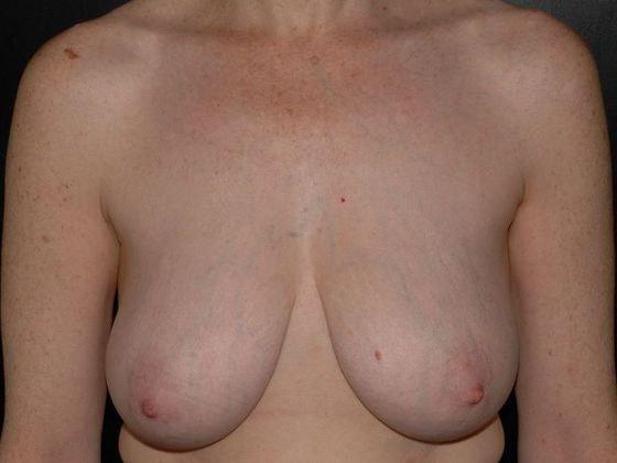 Breast Lift before at Carmel Cosmetic and Plastic Surgeons in Carmel, IN