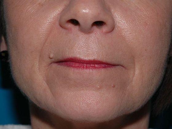 Fat Transfer before at Carmel Cosmetic and Plastic Surgeons in Carmel, IN