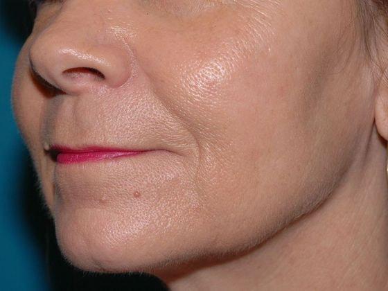 Fat Transfer after at Carmel Cosmetic and Plastic Surgeons in Carmel, IN