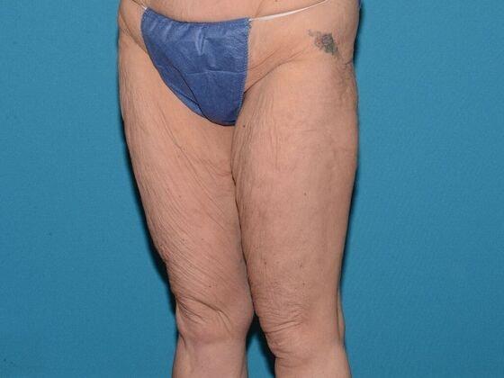 Thigh Lift before at Carmel Cosmetic and Plastic Surgeons in Carmel, IN