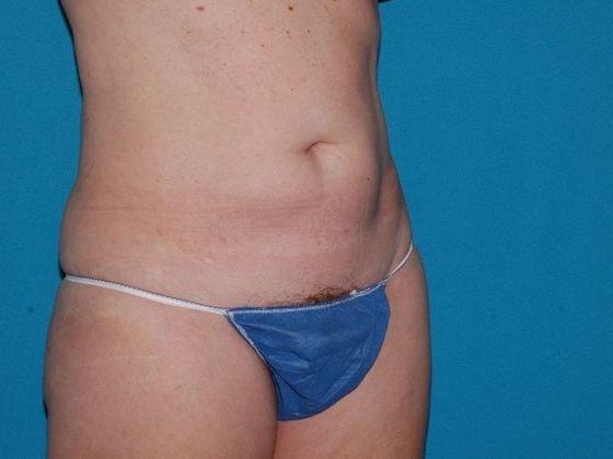 Liposuction before at Carmel Cosmetic and Plastic Surgeons in Carmel, IN
