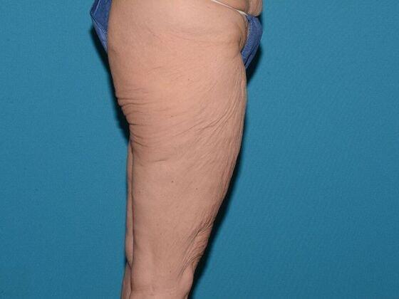Thigh Lift before at Carmel Cosmetic and Plastic Surgeons in Carmel, IN
