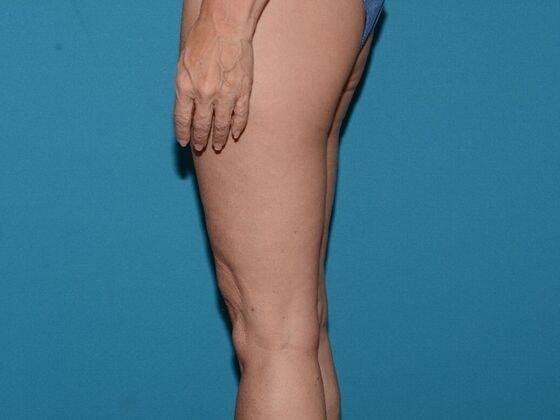 Thigh Lift after at Carmel Cosmetic and Plastic Surgeons in Carmel, IN