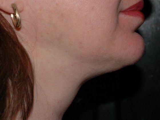 Neck Liposuction after at Carmel Cosmetic and Plastic Surgeons in Carmel, IN